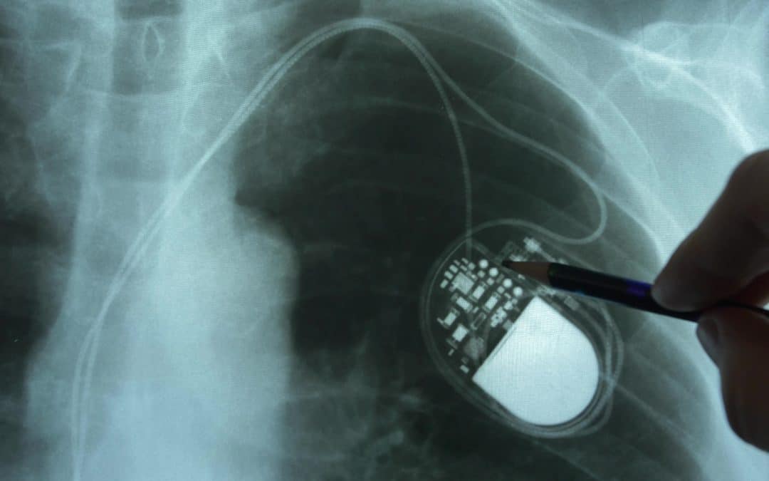 x-ray image of an implanted pacemaker