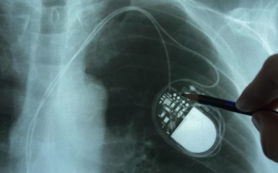 EMFs & Implantable Medical Devices