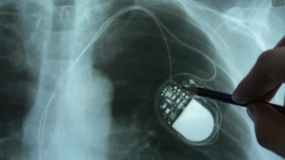 EMFs & Implantable Medical Devices - Radiation Safety Institute of Canada