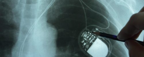 EMFs & Implantable Medical Devices