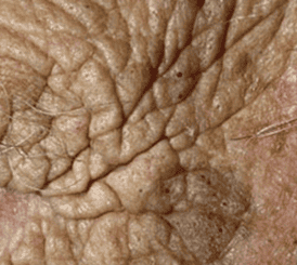 Sun Damaged Skin