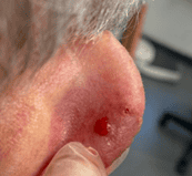 Basal Cell Carcinoma