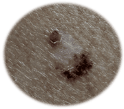 Melanoma