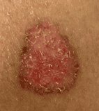Squamous Cell Carcinoma