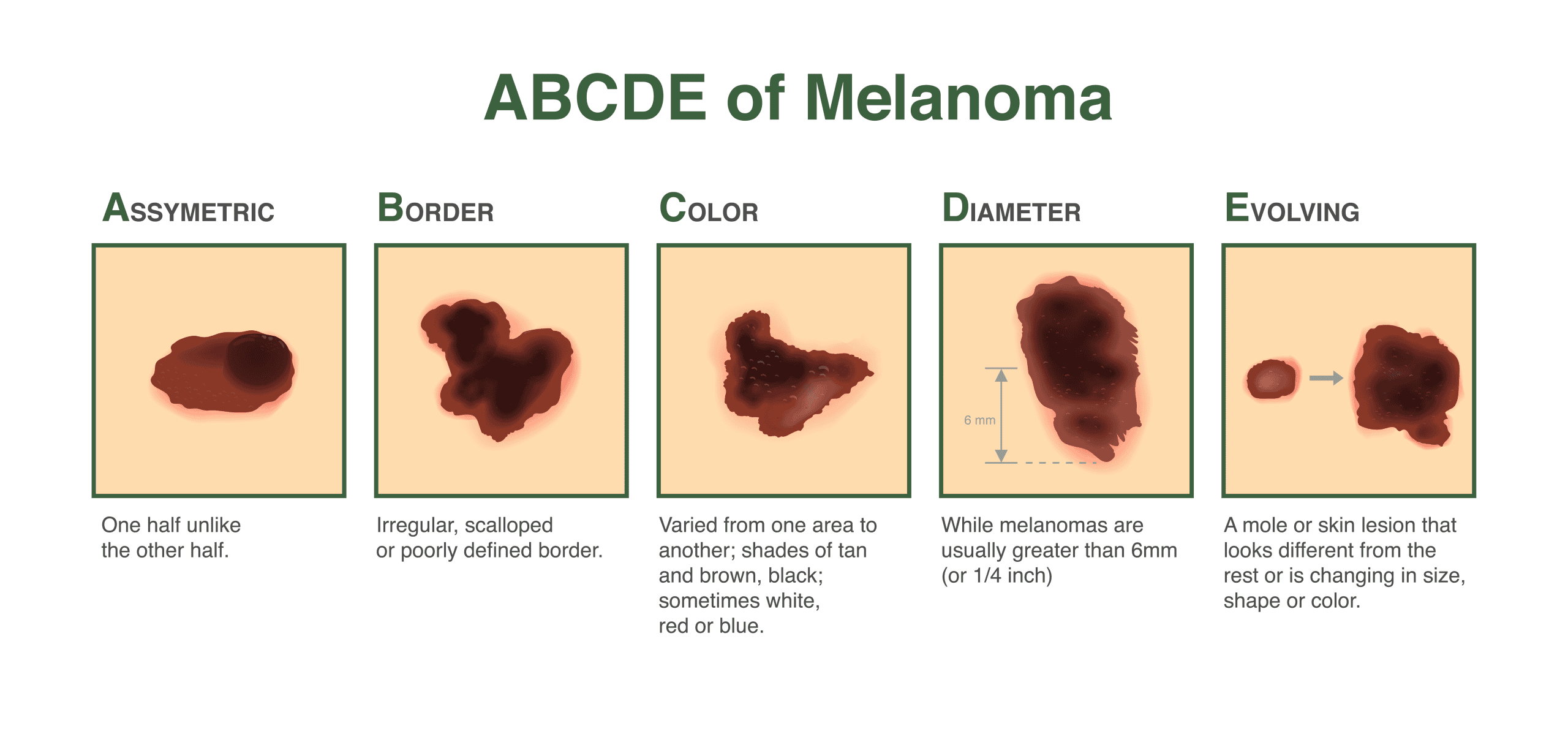 ABCDE of Melanoma: asymmetry, border, colour, diameter, evolving
