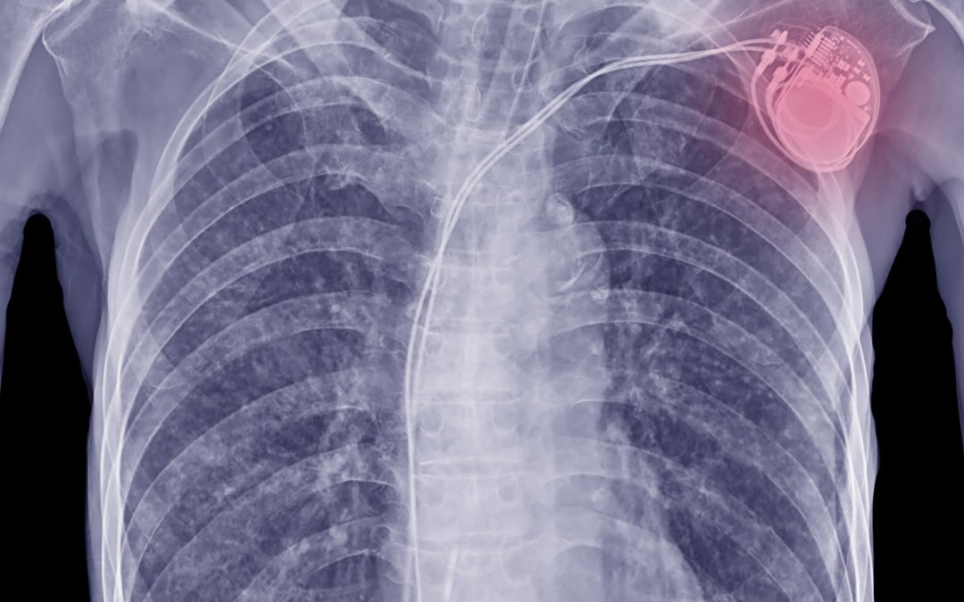 EMF Exposure Standards for Pacemaker Wearers 