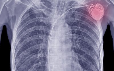 X-ray image that includes a permanent pacemaker.